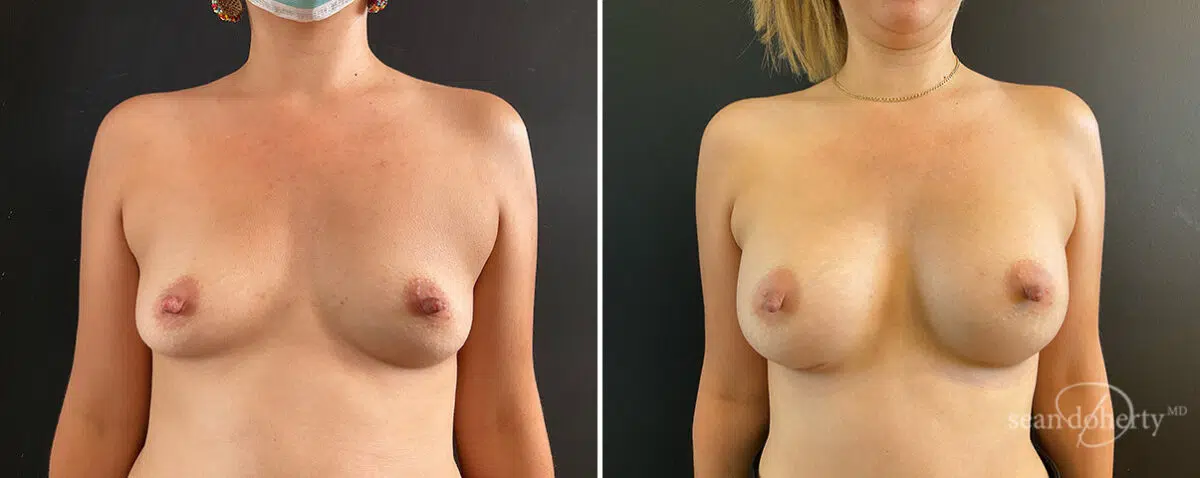 Patient 13841, Breast Augmentation Before and After Photos Breast Augmentation Before and After Photos in Boston, MA, Patient 13841