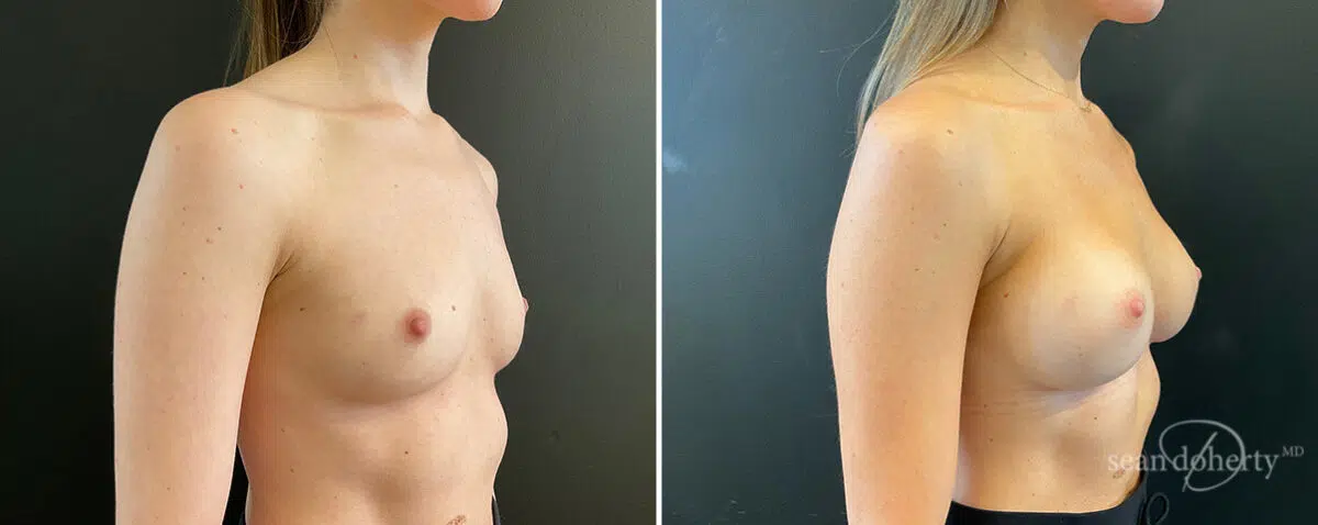 Patient 13857, Breast Augmentation Before and After Photos Breast Augmentation Before and After Photos in Boston, MA, Patient 13857