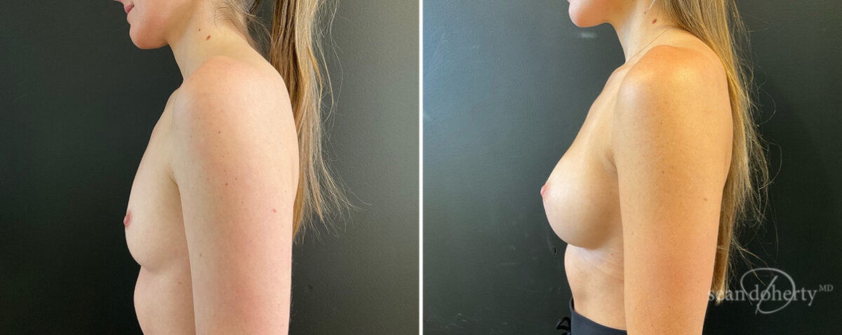 Patient 13857, Breast Augmentation Before and After Photos Breast Augmentation Before and After Photos in Boston, MA, Patient 13857