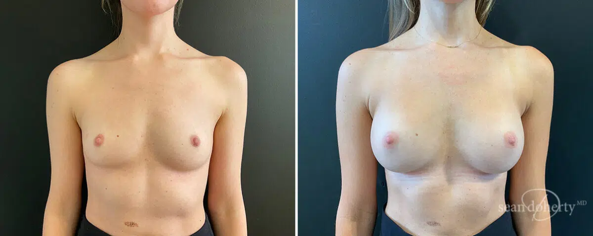 Patient 13857, Breast Augmentation Before and After Photos Breast Augmentation Before and After Photos in Boston, MA, Patient 13857