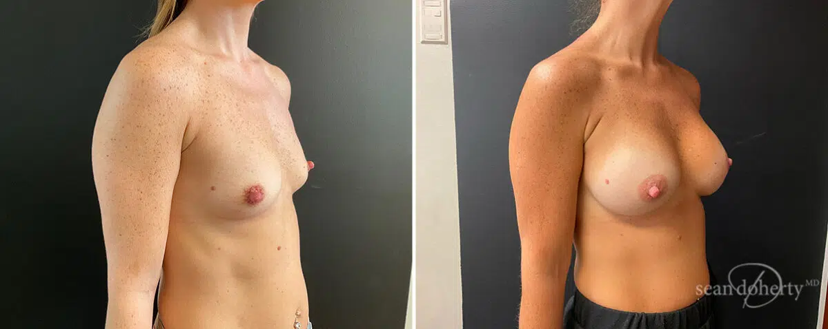 Patient 13873, Breast Augmentation Before and After Photos Breast Augmentation Before and After Photos in Boston, MA, Patient 13873