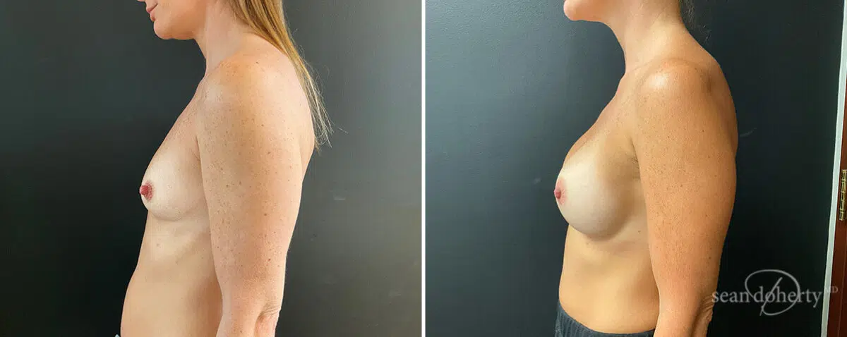 Patient 13873, Breast Augmentation Before and After Photos Breast Augmentation Before and After Photos in Boston, MA, Patient 13873