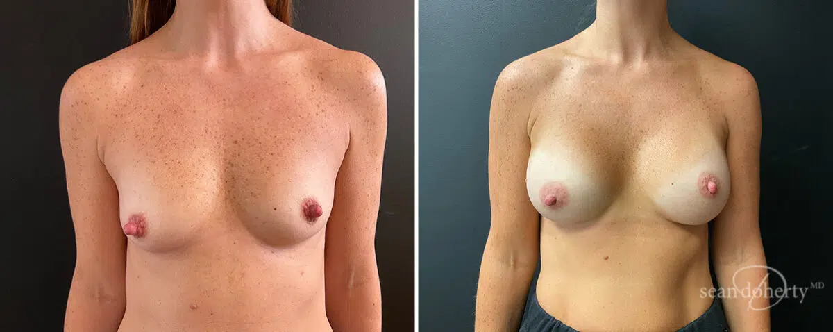 Patient 13873, Breast Augmentation Before and After Photos Breast Augmentation Before and After Photos in Boston, MA, Patient 13873