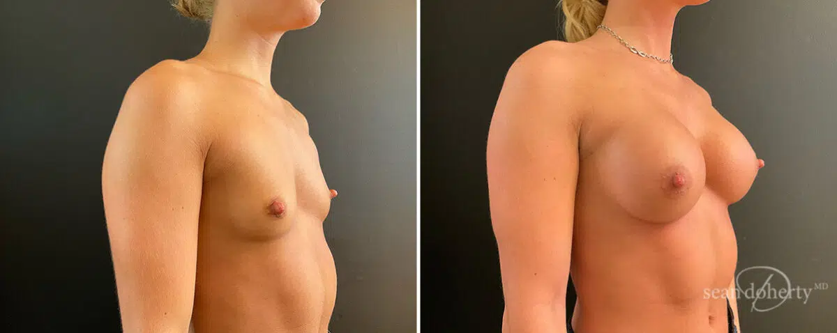 Patient 13889, Breast Augmentation Before and After Photos Breast Augmentation Before and After Photos in Boston, MA, Patient 13889