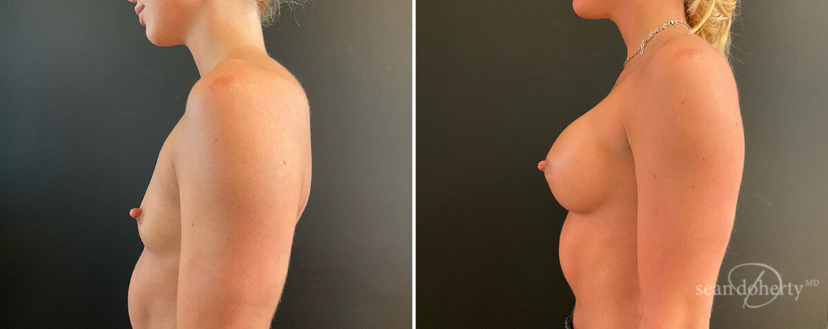 Patient 13889, Breast Augmentation Before and After Photos Breast Augmentation Before and After Photos in Boston, MA, Patient 13889