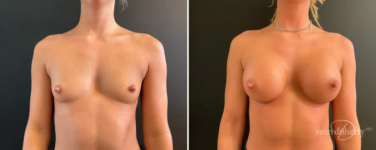 Patient 13889, Breast Augmentation Before and After Photos Breast Augmentation Before and After Photos in Boston, MA, Patient 13889