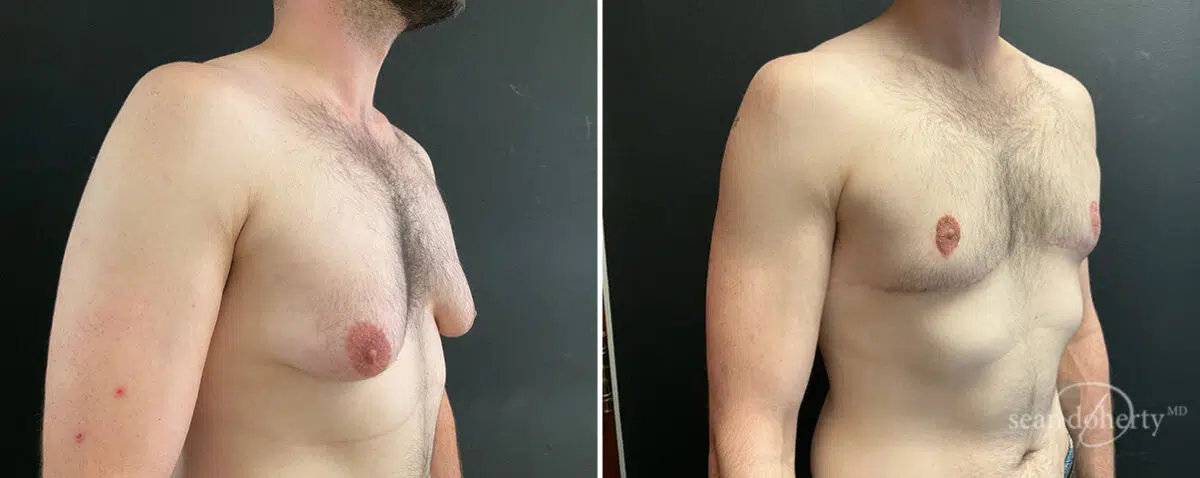Gynecomastia Before and After Photos in Boston, MA, Patient 13908