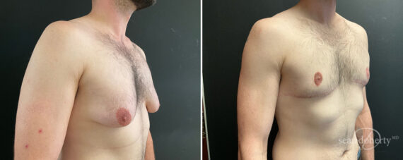 Gynecomastia Before and After Photos in Boston, MA, Patient 13908