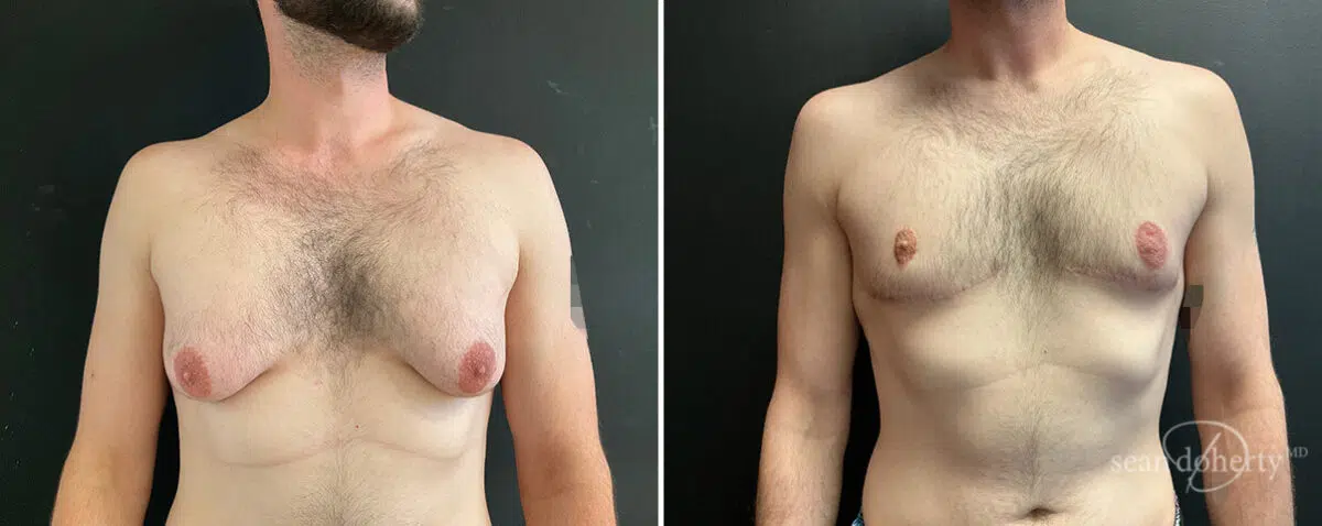 Gynecomastia Before and After Photos in Boston, MA, Patient 13908