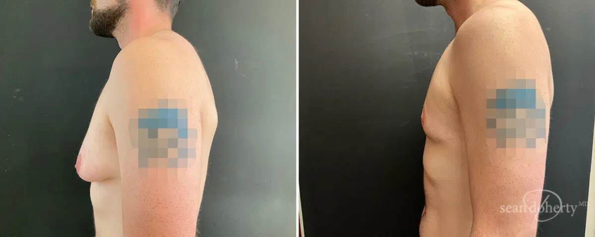 Gynecomastia Before and After Photos in Boston, MA, Patient 13908