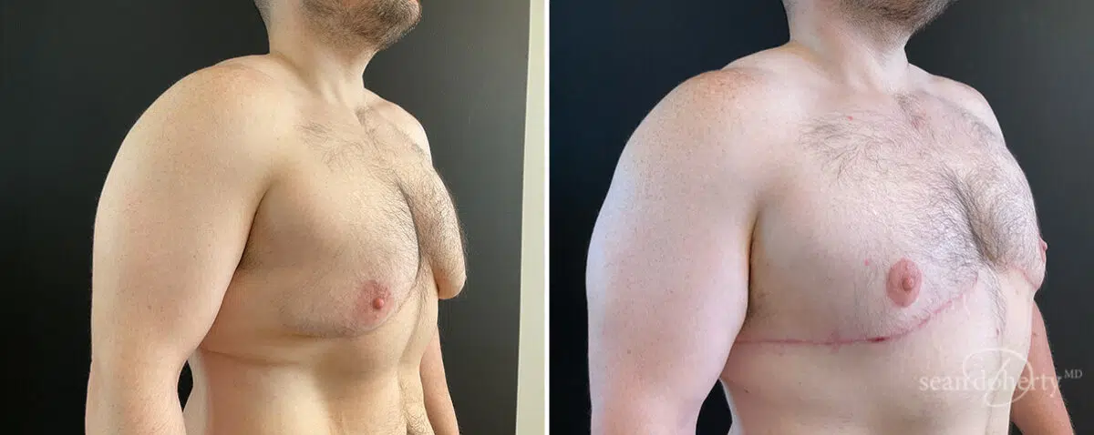 Gynecomastia Before and After Photos in Boston, MA, Patient 13918