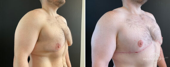 Gynecomastia Before and After Photos in Boston, MA, Patient 13918