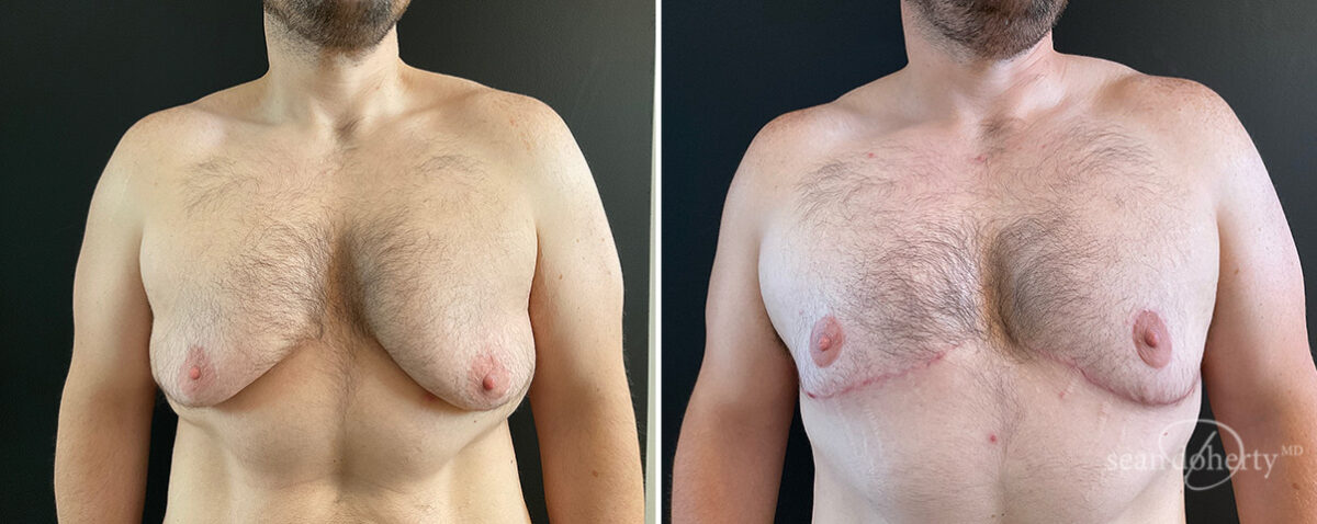Gynecomastia Before and After Photos in Boston, MA, Patient 13918