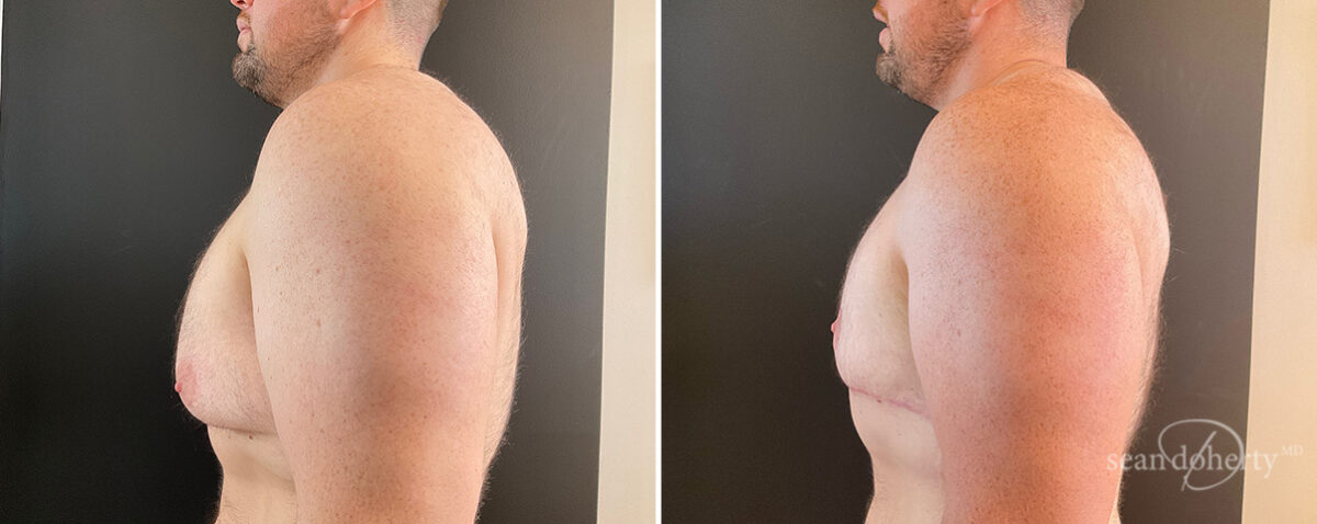 Gynecomastia Before and After Photos in Boston, MA, Patient 13918