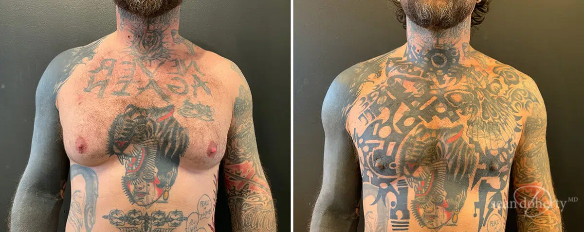 Patient 13928, Gynecomastia Before and After Photos Gynecomastia Before and After Photos in Boston, MA, Patient 13928