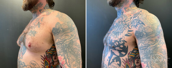 Gynecomastia Before and After Photos in Boston, MA, Patient 13928
