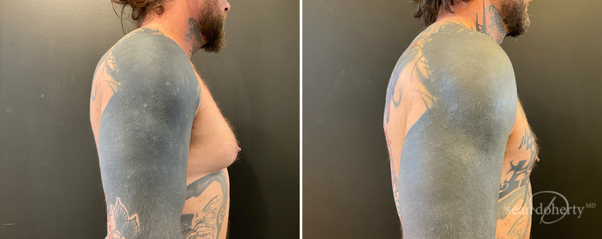 Patient 13928, Gynecomastia Before and After Photos Gynecomastia Before and After Photos in Boston, MA, Patient 13928
