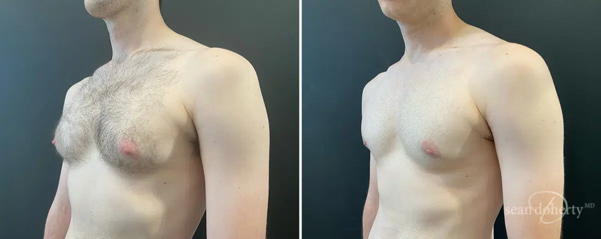 Gynecomastia Before and After Photos in Boston, MA, Patient 13938