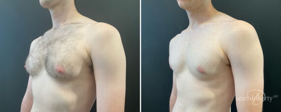 Gynecomastia Before and After Photos in Boston, MA, Patient 13938
