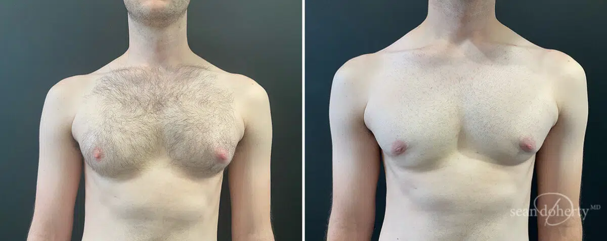Gynecomastia Before and After Photos in Boston, MA, Patient 13938