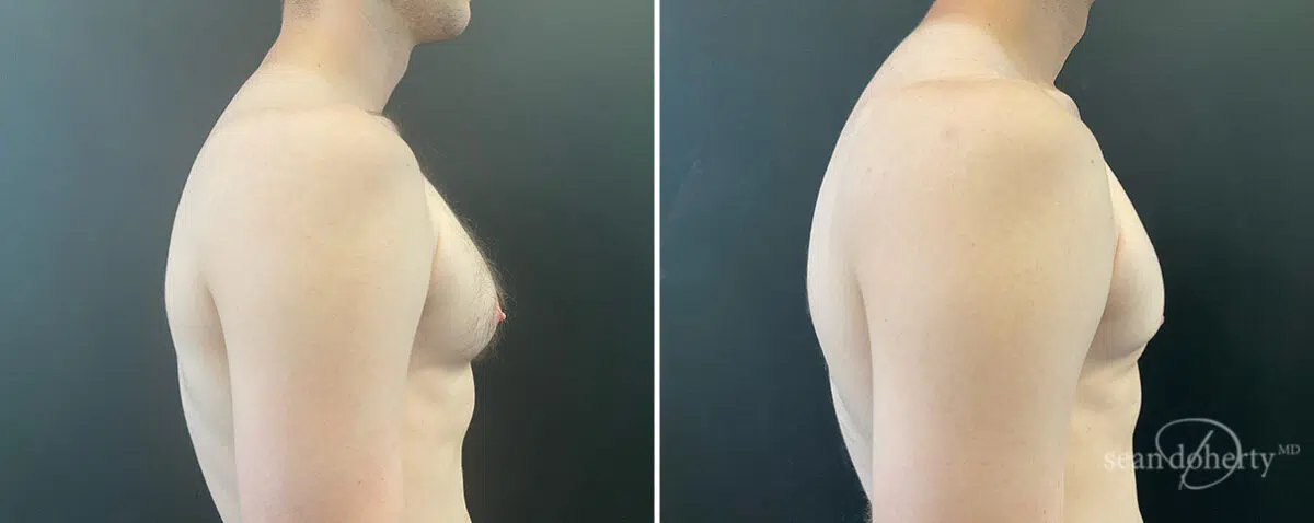 Gynecomastia Before and After Photos in Boston, MA, Patient 13938