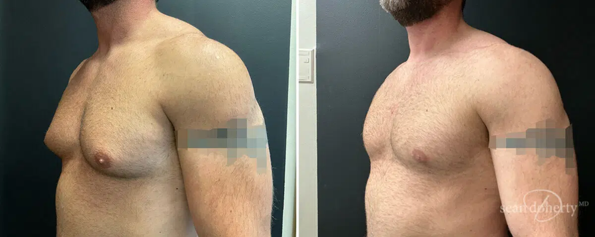 Gynecomastia Before and After Photos in Boston, MA, Patient 13948
