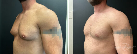 Gynecomastia Before and After Photos in Boston, MA, Patient 13948