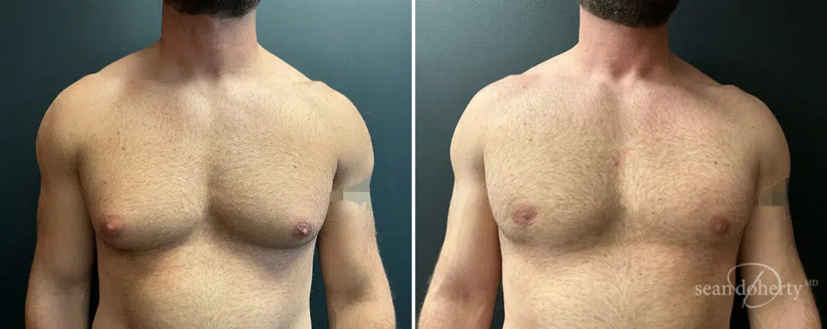 Gynecomastia Before and After Photos in Boston, MA, Patient 13948