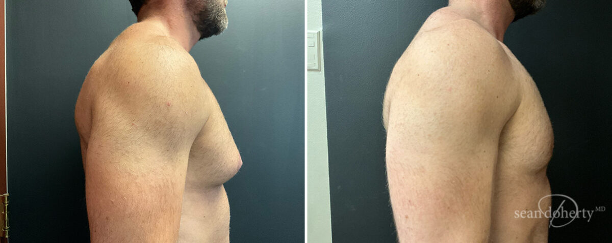 Gynecomastia Before and After Photos in Boston, MA, Patient 13948