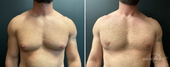 Gynecomastia Before and After Photos in Boston, MA, Patient 13948