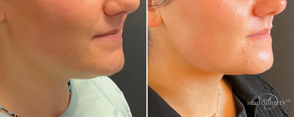Neck Liposuction Before and After Photos in Boston, MA, Patient 13958