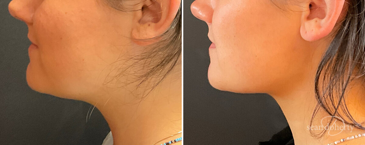 Patient 13958, Neck Liposuction Before and After Photos Neck Liposuction Before and After Photos in Boston, MA, Patient 13958
