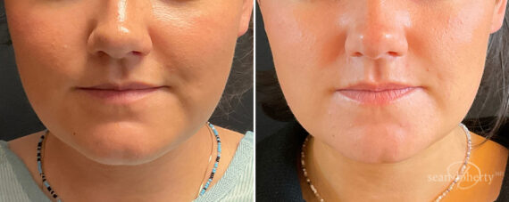 Neck Liposuction Before and After Photos in Boston, MA, Patient 13958