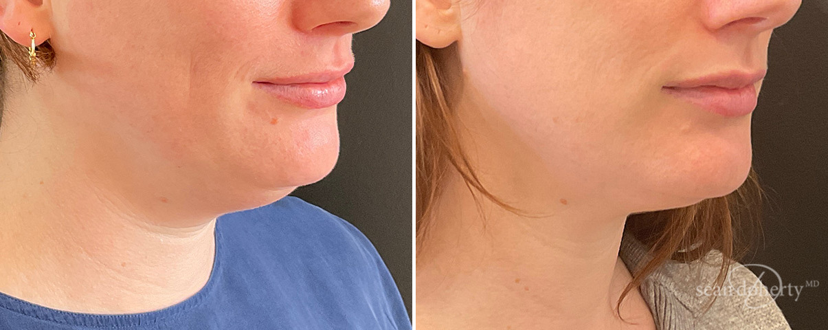 Neck Liposuction Before and After Photos in Boston, MA, Patient 13968