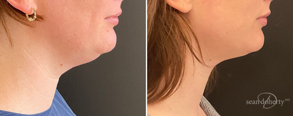 Patient 13968, Neck Liposuction Before and After Photos Neck Liposuction Before and After Photos in Boston, MA, Patient 13968