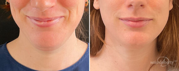 Neck Liposuction Before and After Photos in Boston, MA, Patient 13968