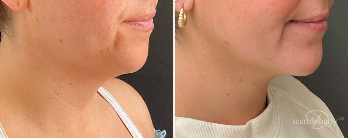 Patient 13978, Neck Liposuction Before and After Photos Neck Liposuction Before and After Photos in Boston, MA, Patient 13978