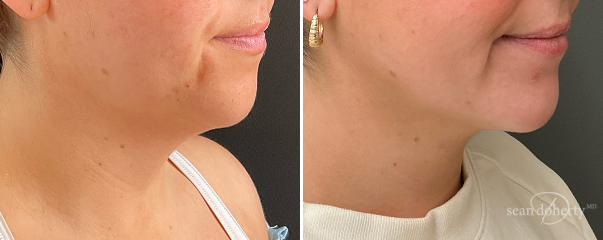 Neck Liposuction Before and After Photos in Boston, MA, Patient 13978
