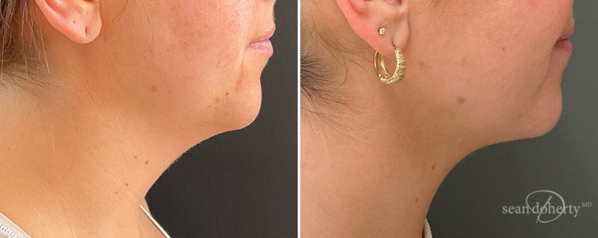 Patient 13978, Neck Liposuction Before and After Photos Neck Liposuction Before and After Photos in Boston, MA, Patient 13978