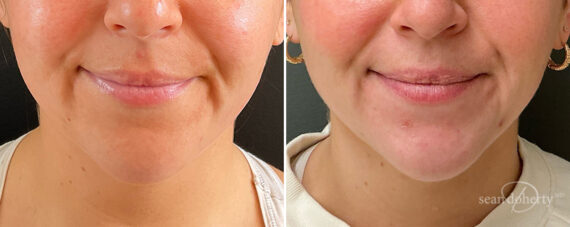 Neck Liposuction Before and After Photos in Boston, MA, Patient 13978