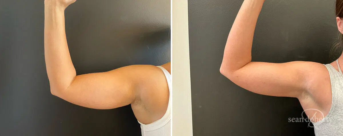 Liposuction Before and After Photos in Boston, MA, Patient 13988