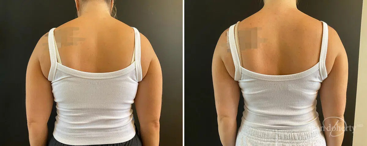 Liposuction Before and After Photos in Boston, MA, Patient 13988