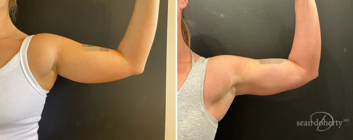 Liposuction Before and After Photos in Boston, MA, Patient 13988
