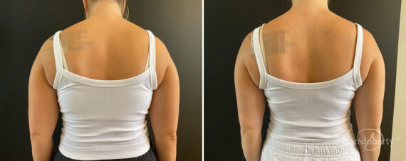 Liposuction Before and After Photos in Boston, MA, Patient 13988