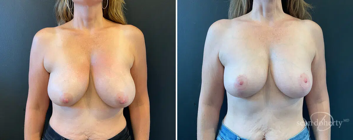 Patient 13998, Breast Lift Before and After Photos Breast Lift Before and After Photos in Boston, MA, Patient 13998