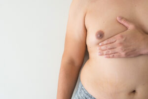Male torso showing signs of gynecomastia with hand covering chest, highlighting need for male breast reduction surgery