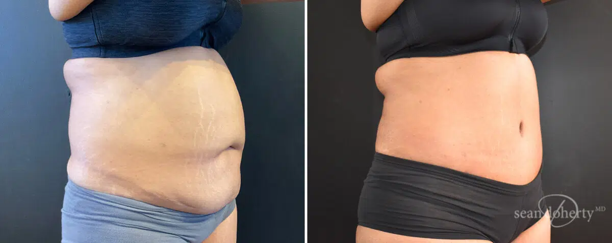 Tummy Tuck Before and After Photos in Boston, MA, Patient 14411