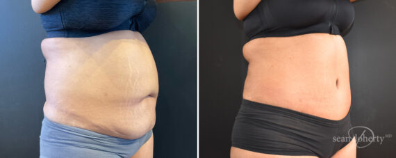 Tummy Tuck Before and After Photos in Boston, MA, Patient 14411
