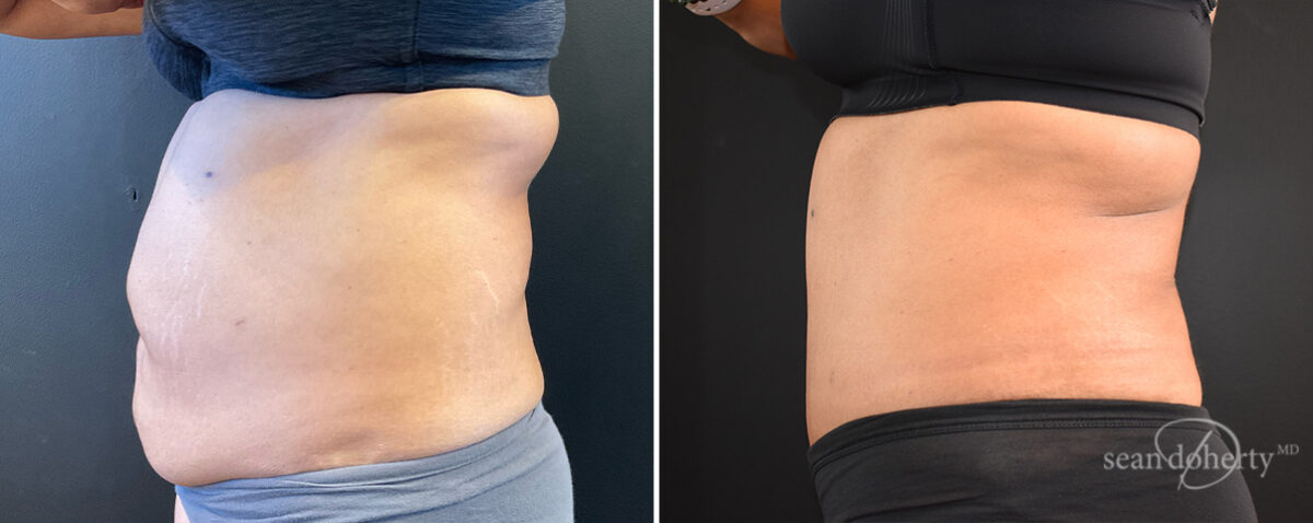 Tummy Tuck Before and After Photos in Boston, MA, Patient 14411