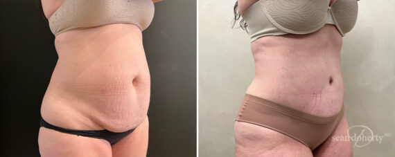 Tummy Tuck Before and After Photos in Boston, MA, Patient 14422